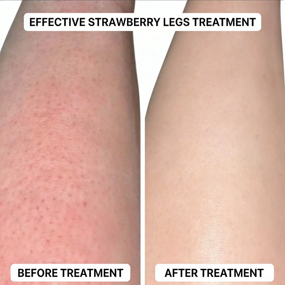 SmoothRoll Ingrown Solution