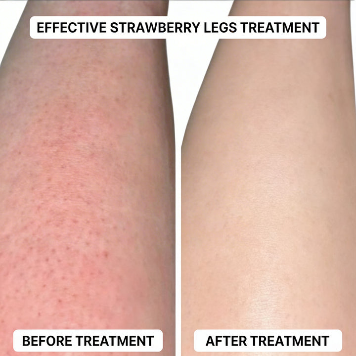 SmoothRoll Ingrown Solution